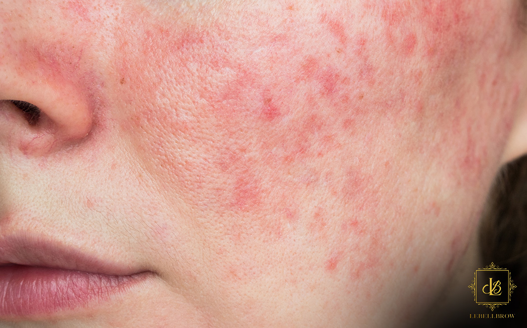 Image of red and irritated skin